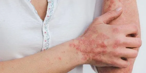 A woman with red spots on her arm and hand.